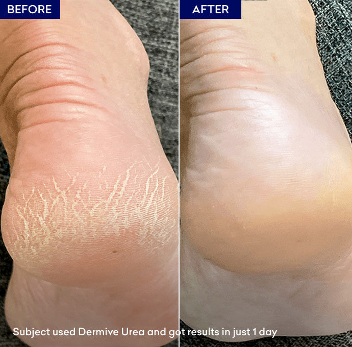 Jenpharm Dermive Urea Moisturizer For Eczema 350ml