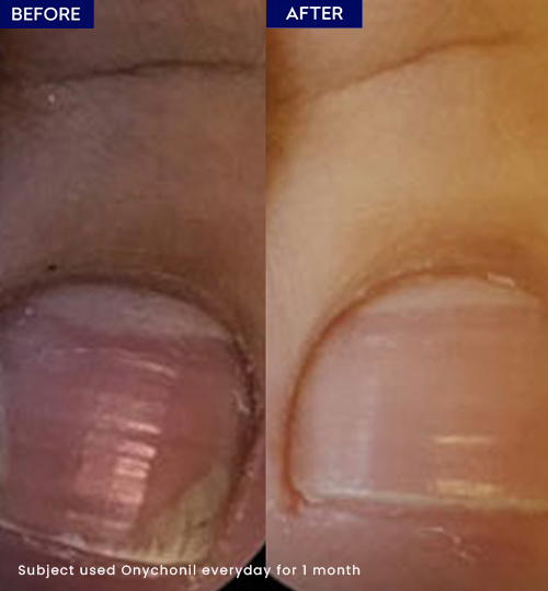 Jenpharm Onychonil Nail Paint 20ml